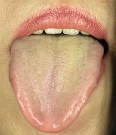 舌苔黄