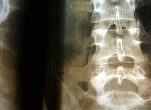 骶骨裂   骶骨裂是一种腰骶部骨骼发育异常,或先天性畸形,由于