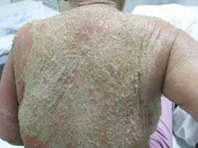 剥脱性皮炎是一种累及全身或几乎全身皮肤的慢性红斑鳞屑性皮肤病