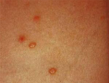 硬下疳开始为在病变部位出现一红色斑疹或丘疹,经1