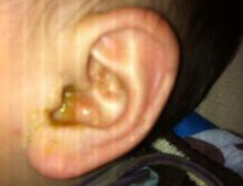 可有水样分泌物,可因耳道肿胀,阻塞,导致听力减退;疖肿在外耳道前壁者