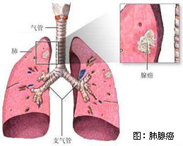 疾病分类