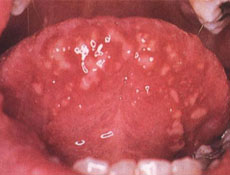 口腔粘膜病