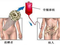 骨髓移植