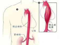 疾病简介