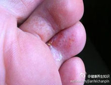 症状诊断/鉴别