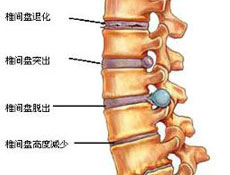 颈椎间盘突出症