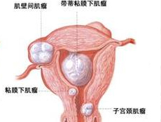 卵巢癌治疗验方偏方