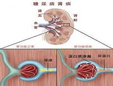 IgA肾炎的发病率