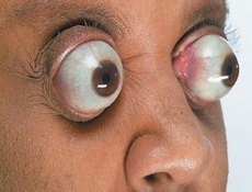 作眼眶ct扫描或mri以寻找眶内原因,眼球突出的程度可用眼球突出计测量