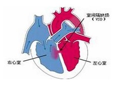 室缺封堵术的适应范围