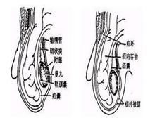 小肠疝气