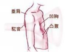 漏斗胸指胸骨,肋软骨及部分肋骨向背侧凹陷畸形形成漏斗状,绝大多数