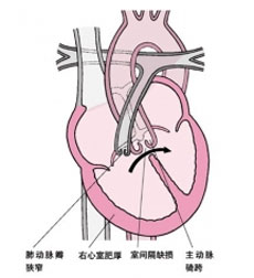 室缺心外科治疗原则