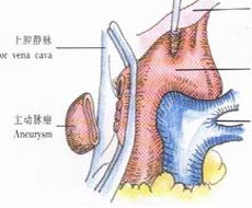 胸主动脉瘤预防保健