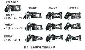 颈椎骨折分类