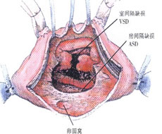 VSD的治疗指南