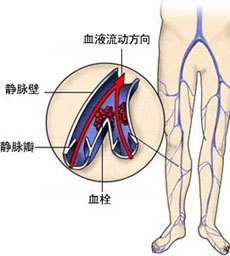 诊断标准