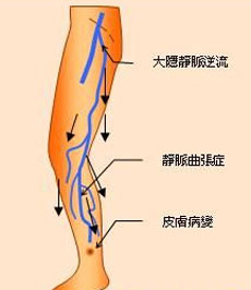 肢体营养障碍