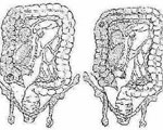 左右结肠癌不同之处介绍