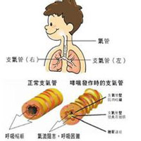 过敏性哮喘