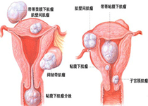 恶性肿瘤