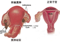 葡萄胎