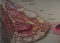 乳腺导管扩张