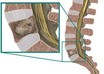 脊柱原发恶性肿瘤影响预后的因素