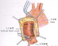 病理生理