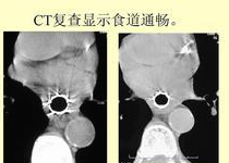 放化疗的副作用