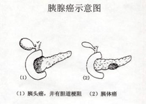 早期症状