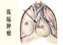 胸内甲状腺及胸腺瘤 