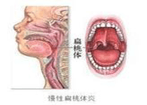 并发症