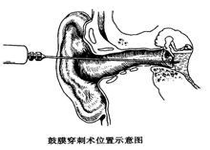 中耳炎类型