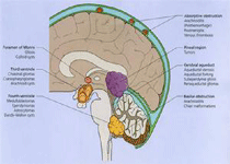 良性颅内压增高病因机理