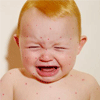 小儿麻疹临床表现