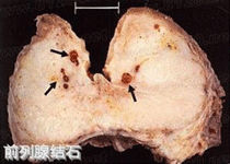 前列腺结石