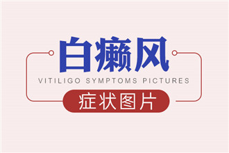 包河哪个医院治白癜风好*白癜风部位为什么开始发痒？
