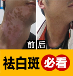 白癜风饮食事项有哪些需要注意的