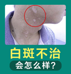 白癜风的白斑一直在扩散该如何是好