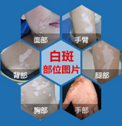 治疗了为何还会有新白斑出现