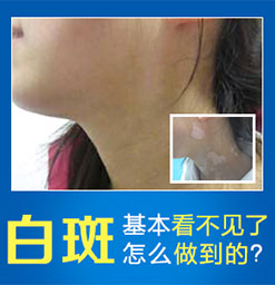 塘厦正规治白癜风医院：初期白癜风的特点是什么