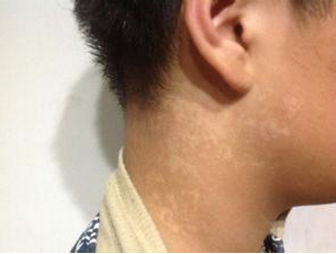 南昌男性患了白癜风要注意哪些事情