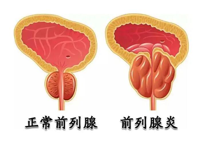 成都新都治疗前列腺炎医院