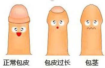 包茎和包皮过长有什么区别？