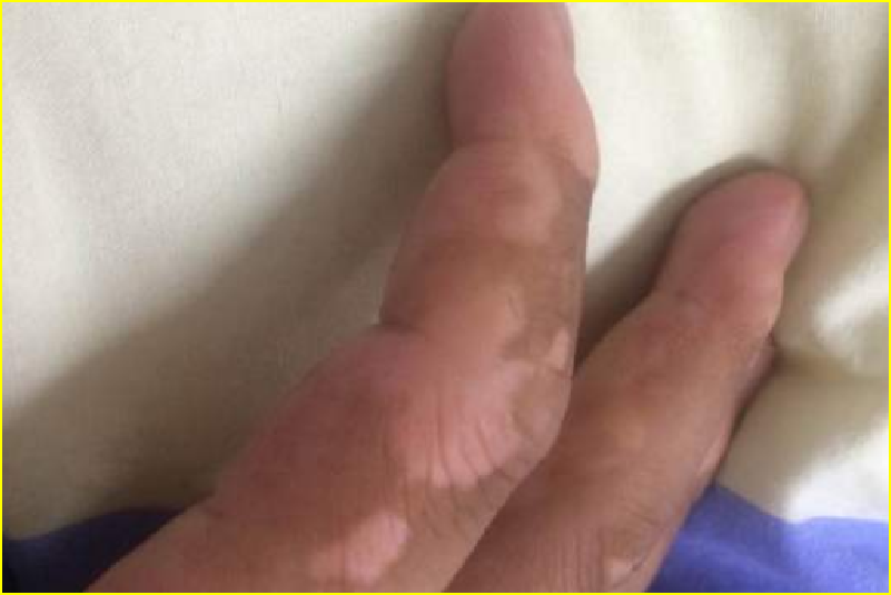 淮安治疗白斑病专科医院那里好?闷热时节怎么预防
