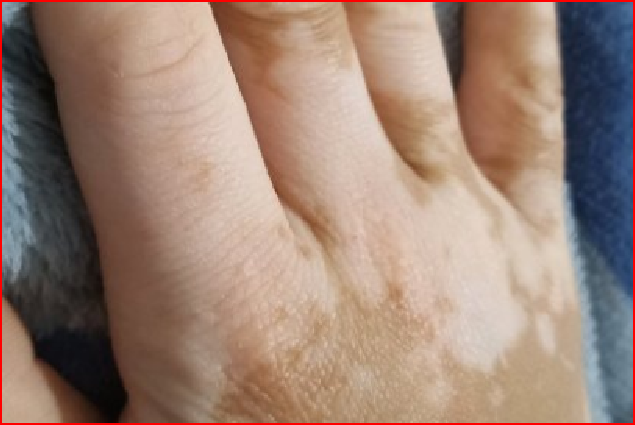 轻度白癞风前期症状 怎么预防扩散