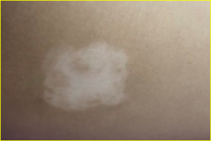 轻度白癞风的治疗费是多少