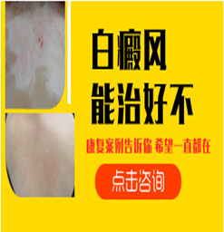 南京白癜风治疗哪家好？白斑怎么护理